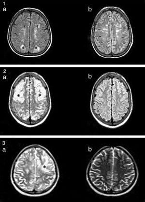 1.a. Lesiones hiperintensas en FLAIR, córtico-subcorticales, simétricas, parieto-occipitales (*). b. Evidencia de mejoría luego de 3 meses. 2.a. Imágenes hiperintensas en FLAIR, bien definidas, bilaterales, que comprometen regiones córtico-subcorticales, fronto-parieto-temporo-occipitales bilaterales (*). b. Evidencia de mejoría a los 2 meses. 3. Lesión hiperintensa en T2 (*). No se evidencian alteraciones en la secuencia de difusión.