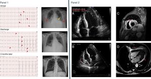 Panel 1: Top, ECG (left panel) and CXR (right panel) at admission. At the ECG sinus tachycardia and ST-segment elevation from V2-V6 are visible (red arrows); the CXR shows cardiomegaly (yellow arrow) and bilateral pulmonary congestion (red arrows). Middle, the same tests at discharge. ECG with sinus rhythm and deep negative T waves from V2-V6 and in I and AvL (red arrows); CXR with clear lung fields. Botton, ECG and CXR 3 months after the episode. ECG shows normalization of the T wave, and CXR is normal. Panel 2: A: Echocardiogram at admission showing severe LV dysfunction (28.7% calculated by Simpson method). B: four chambers views from the echocardiogram at admission showing pericardial effusion (red arrow). C: short-axis view from a Cardiac MR (STIR sequence) showing more white density in the anterior and septum zone suggesting myocardial edema (red arrow). D: four chambers view from a Cardiac MR (CINE sequence) showing generalized pericardial effusion (red arrows).