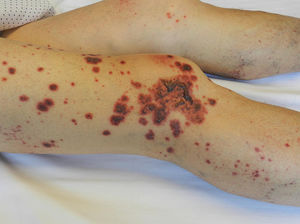 Imagen clínica del paciente que presentaba púrpura palpable en extremidades inferiores con formación de ampollas hemorrágicas.