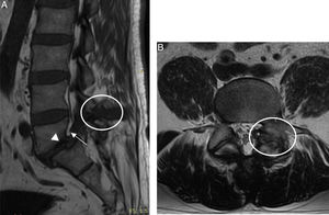 RM columna lumbosacra. A) Plano sagital en T1 con imagen hipointensa en espacio interespinoso L4-L5 (círculo) que invade el neuroforamen (flecha) y espondilolistesis de L5 (cabeza de flecha). B) Plano axial en T2 con imagen heterogénea en articulación facetaria izquierda con lisis bilateral de la pars interarticular (círculo).
