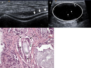 A) Imagen de doble contorno del cartílago femoral (flechas). B) Quiste de Baker de paredes gruesas (círculo) con puntilleo hiperecoico en su interior (cabezas de flechas). C) Material amorfo anfófilo acelular (estrella) bordeado por histiocitos epitelioides (doble flecha) y células gigantes multinucleadas (flecha) que fagocitan este material.