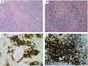 Biopsia de laringe. Hematoxilina-eosina: A) Infiltrado inflamatorio crónico (×100). B) Infiltrado de tipo linfoplasmocítico (×200). C) Mediante técnicas inmunohistoquímicas, células plasmáticas CD138+ (×100). D) Tinción específica para IgG4 (×100).