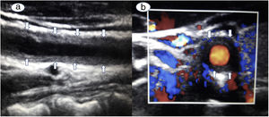 Ultrasound B mode scanning of the right carotid artery on longitudinal [a] and transverse [b] cuts, showed homogenous, mid-echoic, circumferential wall thickening.