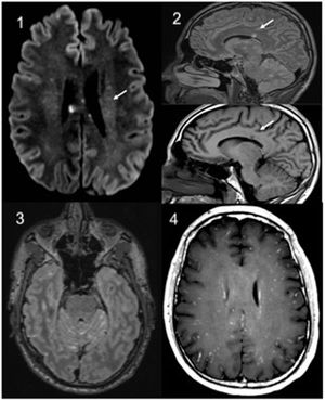 RM cerebral: 1: Axial. Difusión con lesiones puntiformes hiperintensas en relación con microinfartos. 2: Sagital, Flair T2 y sagital T1. Afectación característica del cuerpo calloso. 3: Axial Flair T2 con cte. Hiperseñal y realce leptomeníngeo (señal aditiva T1 cte + T2). 4: Axial T1 cte con patrón de capación «miliar».