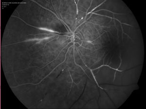 Angiofluoresceingrafia: Isquemia en área temporal, oclusión arterial y vasculitis activa en polo nasal.