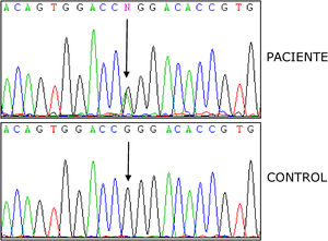 Mutación p.R92Q en heterocigosis. Exón 4, gen TNFRSF1A.