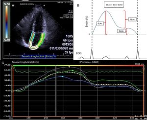 A) Imagen en vista apical 4 cámaras donde se determinan los bordes de la aurícula izquierda para el cálculo del strain. B) Representación gráfica del strain de la aurícula izquierda en todo el ciclo auricular. La SLAr correspondió al valor desde el pico más alto de la fase de reservorio, la SLAb al pico más alto de la fase de bomba y la SLAc a la diferencia entre SLAr y SLAb. C) Representación del reporte de strain de aurícula izquierda del software VVI. SLAr: strain logitudinal aurícula reservorio; SLAb: strain longitudinal aurícula bomba; SLAc: strain logitudinal aurícula conducto.