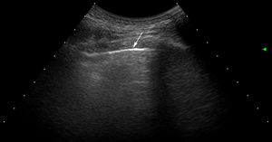 Examen de US pulmonar en sujeto sano. Nótese que la pleura es una banda hiperecogénica lineal y regular (flecha). No hay presencia de líneas B.