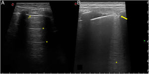 Ecografía pulmonar normal y con enfermedad pulmonar intersticial. Imágenes ecográficas representativas de pulmón normal y patológico. A). Patrón pulmonar normal. Se aprecia una línea pleural fina y regular (flecha fina), visible entre los rebordes costales, que dejan sombra posterior, así como la presencia de líneas A (asteriscos), que son las líneas hiperecoicas, horizontales, situadas por debajo de la línea pleural a intervalos regulares. B). Patrón pulmonar patológico. La línea pleural muestra irregularidad, engrosamiento y fragmentación (flecha gruesa). Se observan líneas B (asterisco), que son las líneas hiperecoicas verticales que surgen de la línea pleural y se extienden hasta la profundidad sin desvanecerse, borrando las líneas A.