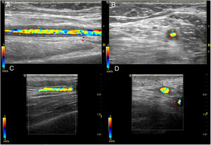 Ecografía de arteria temporal normal y con arteritis de células gigantes. Signo del halo de arteria temporal en corte longitudinal (A) y transversal (B). Se aprecia el engrosamiento de la pared de la arteria temporal (asteriscos). En las imágenes C y D se muestran imágenes ecográficas de arteria temporal normal en corte longitudinal y transversal, respectivamente.