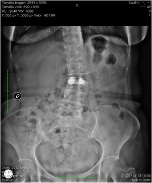 Radiografía anteroposterior de columna vertebral lumbar.