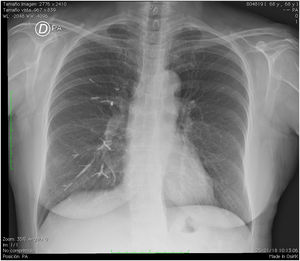 Radiografía posteroanterior de tórax.