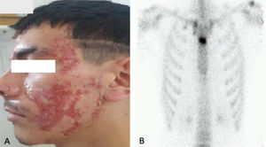 A) Acné fulminans. B) Signo de la cabeza de toro en centellograma óseo.