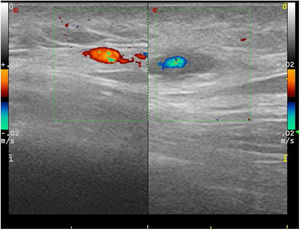 Ecografía Doppler con sonda lineal sobre nódulo doloroso palpable. A la derecha, se observa área hipoecoica perivascular que corresponde a nódulo clínico. A la izquierda, arteria temporal contralateral sin datos de enfermedad.