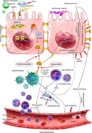 Patogénesis del síndrome de distrés respiratorio agudo (SDRA) que se desencadena después de una lesión inicial que interactúa a través de receptores de alarmina y TLR que activan factores de transcripción nuclear, incluido NF-κB. Posteriormente, una potente respuesta inmune aguda desencadenada principalmente por IL-1ß provoca la activación y el reclutamiento de macrófagos/neutrófilos. La respuesta inmune mediada por células produce daño tisular, lo que permite el desarrollo de edema y daño epitelial. IL: interleucina; MAPK: proteína quinasa activada por mitógeno; MMPs: metaloproteinasas de la matriz extracelular; NETs: trampas extracelulares de neutrófilos; PAMPS: patrón molecular asociado a patógenos; ROS: especies reactivas de oxígeno; TLR: receptor tipo toll. Fuente: versión adaptada del original de Aranda-Valderrama P. et al. Ilustrador científico: Miguel Soto.
