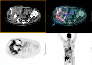 PET/TC realizada a los 60min de la administración intravenosa de 200,14MBq de 18F-FDG. Imágenes de emisión y corregidas por atenuación con TC de baja dosis, desde la calota hasta el tercio superior de los muslos (protocolo whole body). Se aprecia una masa hipermetabólica en la región ilíaca derecha, multilobulada, de aproximadamente 15×13cm y alta intensidad de captación (SUVmáx 14,64). Engloba el material protésico de la cadera y se extiende cranealmente hacia el músculo ilíaco, produciendo destrucción ósea de la pala ilíaca, la articulación coxofemoral y el isquion (flecha). Asocia zonas ametabólicas indicativas de componente necrótico/quístico (estrella).