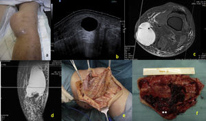 (a) Clinical aspect of the soft tissue mass in the medial knee, (b) gray scale ultrasound showing a 16cm long well defined anechoic mass (area: >15.6cm2) without synovial hypertrophy in the pes anserinus bursa, (c) MRI with axial T1 view showed a homogeneous soft tissue mass at the enthesis of pes anserinus conjoint tendon with peripheral enhancement (*). Absence of hemosiderin deposits and no evidence of bone or joint involvement, (d) T1 coronal view of the bursa, (e) Intraoperative image of the lesion showed multiple yellow to brown nodules inside the pes anserinus bursa, (f) 15cm large bursa excision pathology confirmed the pathology (**).