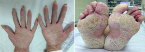 Imágenes de psoriasis palmo-plantar en un paciente en tratamiento con anti-TNF.