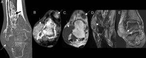 OCS extraarticular extensa. A) TC sin contraste en plano coronal que muestra extensa calcificación irregular en la membrana interósea (flecha negra) y masa de partes blandas en cara lateral del tobillo con escasa mineralización (flecha blanca). B) TC sin contraste en plano axial que muestra masas de partes blandas en cara dorsal y en cara lateral del tobillo, con incipiente mineralización difusa (flechas). C) RM con secuencia axial T1 sin contraste que muestra las mismas masas que en B (flechas), isointensas con respecto al músculo. D) RM con secuencia axial DP Fat Sat, que muestra una masa de partes blandas adyacente a la base del quinto metatarsiano, de intensidad de señal intermedia por incipiente mineralización difusa (flecha). E) RM con secuencia coronal T2 GRE que muestra la masa de partes blandas en cara lateral del tobillo extendiéndose al seno del tarso (flecha).