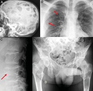 Serie ósea radiográfica. A) Múltiples lesiones líticas en calota con contornos geográficos y sin esclerosis. B) Las flechas señalan lesiones osteolíticas en el cuarto y sexto arcos costales posteriores derechos. C) Fractura-aplastamiento de L4. D) Extensas lesiones líticas en sacro, pelvis y ambos fémures.