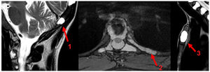 Imágenes de RM donde se identifican lesiones óseas focales hiperintensas. En planos sagital STIR de calota craneal (flecha 1) y esternal (flecha 3). Imagen en el plano axial T2 Med del quinto arco costal posterior izquierdo (flecha 2).