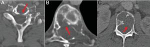 TC con ventana de hueso de columna cervical, dorsal y lumbar. Múltiples lesiones líticas con destrucción de la cortical ósea (flechas). A) En el margen posterior del cuerpo vertebral C6. B) En el margen posterolateral derecho del cuerpo vertebral T8. C) En el margen posterolateral izquierdo del cuerpo vertebral L3.