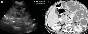 A) Ecografía abdominal. B) TC de abdomen con contraste intravenoso en fase venosa portal. Gran esplenomegalia multiquística de 20cm de diámetro longitudinal en relación con linfangioma difuso.