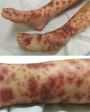 Lesiones purpúricas con ampollas hemorrágicas en extremidades inferiores.