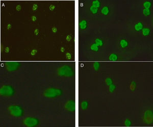 ANCA patterns observed by IIFT in patients included in the study: (a) C-ANCA, (b) P-ANCA, (c) Atypical ANCA, (d) Atypical ANCA with granulocytes specific ANA.