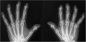 Hand radiograph showing gull-wing deformities in DIP joints.