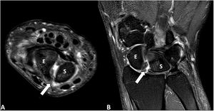 Resonancia magnética. Imágenes axial (A) y coronal (B) de la muñeca izquierda en secuencias potenciadas en T2 con supresión grasa (SPAIR). Se objetiva una rotura completa de la porción dorsal del ligamento escafosemilunar (flecha) que produce una diástasis significativa entre el hueso escafoides (E) y el semilunar (S) con mínima cantidad de derrame y signos de sinovitis. No se objetivan focos de señal de resonancia similar a edema óseo que sugieran inflamación/artritis ni cambios artrósicos significativos.