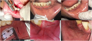 Casos a los que se les realizó BGSM. Caso 1: 1a)Incisión quirúrgica y aplicación inicial de PANT. 1b)Incisión en proceso de reparación después de las dos aplicaciones de PANT (1h posterior a la toma de biopsia). 1c)Mucosa labial en la zona de la toma de biopsia regenerada a los dos días. Caso 2: 2a)Incisión quirúrgica. 2b)Incisión en proceso de reparación después de las dos aplicaciones de PANT (1h posterior a la toma de biopsia). 2c)Mucosa labial regenerada a los 3días de la toma.