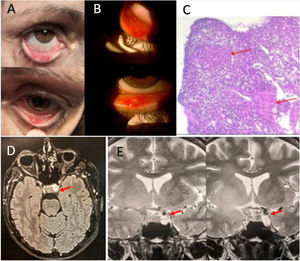Observaciones clínicas, imagenológicas y de anatomía patológica de jerarquía. A: Lesiones conjuntivales nodulares, sobre base eritematosa. B: Múltiples lesiones redondeadas amarillo-eritematosas, menores de 2mm de diámetro. C: Biopsia de los nódulos conjuntivales, donde se observan granulomas no caseificantes, compatibles con sarcoidosis (flechas rojas) (gentileza del Dr. Naves Ariel, Anatomía Patológica, Instituto de Histopatología, Rosario, Santa Fe, Argentina). D: RM corte axial con lesión ocupante de espacio selar izquierda (flecha roja). E: RM corte sagital, lesión de 10×10mm, con compromiso del seno cavernoso, donde engloba a la arteria carótida interna izquierda (flechas rojas).