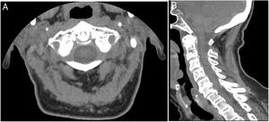Axial (A) and sagittal (B) CT images of the patient's cervical spine, representing calcium pyrophosphate dihydrate crystals deposition around the odontoid process of C2 (red arrows).