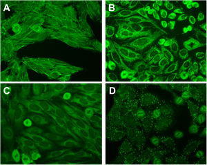 Example cytoplasmic staining on the HEp-2 substrate. (A) F-actin staining suggesting the presence of smooth muscle antibodies found in autoimmune hepatitis and related disorders. (B) Coarse, granular cytoplasmic staining suggestive of anti-mitochondrial antibodies found in primary biliary cirrhosis. (C) Smooth, homogenous cytoplasmic staining suggestive of anti-ribosomal P antibodies found in systemic lupus erythematosus. (D) Large cytoplasmic dots staining suggestive of anti-GW bodies. All micrographs are taken at a magnification of 400×.