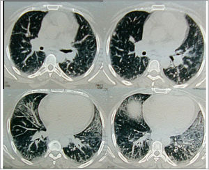 Axial HRCT images at level 3 and 4 in a 38 year-old female show mixed reticular and GGO patterns as septal thickening in lung bases and limited patchy areas of GGO. This patient had FVC 61% of predicted value (mild restriction pulmonary impairment). A predominant reticular pattern and a coarseness grade of 3 were assigned.