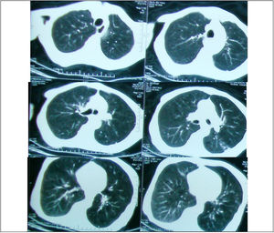 HRCT of axial images at level 1, 2 and 3 in a 43 years old female reveals bilateral ground glass opacification with fine reticulation. The patient had FVC 80% predicted value (normal pulmonary function). Predominant GGO and coarseness grade of 1 where was assigned.