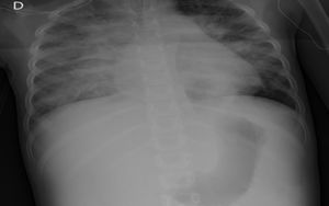 Portable chest X-ray. Bilateral pulmonary parenchymatous opacity of central predominance, compatible with pulmonary edema. Mild bilateral pleural effusion of right-dominance.