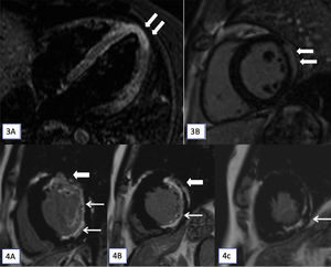 (3A and 3B): T2-STIR (short tau inversion recovery) cardiac magnetic resonance imaging (CMR) images in horizontal (A) long axis show myocardial hyperintense signal in the apex (arrows). Late gadolinium enhancement (LGE) apical short axis image shows confluent epicardial predominant myocardial enhancement. On cine cardiac MRI imaging only subtle hypokinesis was seen (not shown here). (4A–4C): CMR, LGE images in short axis at base (A), mid cavity (B) and at apex (C) shows transmural enhancement in the anterior segments (thick arrow in A and B) and sub-endocardial in lateral and inferior segments (A and B) and at apex (C) in the left anterior descending and left circumflex territories (7/17 segments).