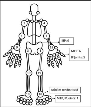 Frequency of joint involvement in post-COVID ReA patients.