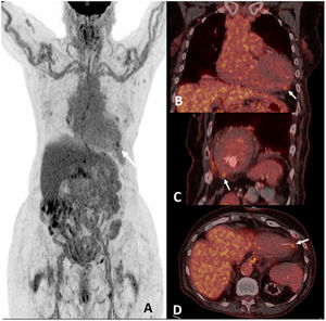 PET/CT with 18F-FDG. Anterior view of the whole-body MIP (maximum intensity projection) image, showing a hot spot on the myocardial apex (white arrows) (A); in coronal (B), sagittal (C) and axial (D) fused images of the PET/CT scan.