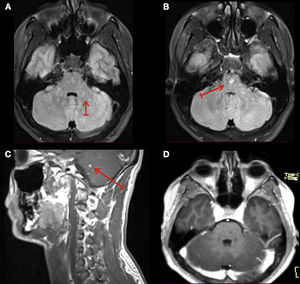 (A, B) MRI of the brain T2 Flair at presentation with hyperintense lesions (arrows). (C) MRI of the brain T1 post-gadolinium at presentation, showing foci of pontine “peppering” enhancement lesion highly suggestive of a perivascular distribution. (D) MRI of the brain T1 post-gadolinium at one-month follow-up showing full recovery after corticosteroids treatment.