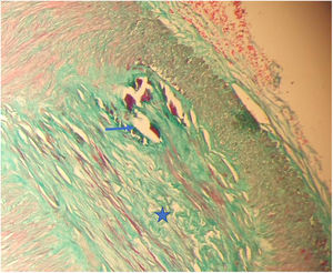 Masson Trichrome, 200×. The histopathological evaluation of temporal artery biopsy specimen; Monckeberg's medial sclerosis characteristics with degeneration (star) and calcification (arrow) in the internal elastic lamina in tunica media and obliteration in lumen of medium-large-sized vessel.