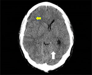 Image of chronic subdural hematoma (yellow narrow) and large, with rebleeding areas and large mass effect with ipsilateral ventricular compression and 9mm midline deviation (white narrow).