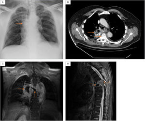 (A) Chest X-ray: right paratracheal infiltrates. (B) Chest CT: right lung consolidation occupying the azygo-esophageal recess, with aire-fluid level and calcium deposits, as well as a marked crush and destructuring located at the T5-T6. (C) Thoracic spine MRI (coronal): central necrotic-cystic zone occupyping the disc space of the T5-T6 and fistulous communication with the adjacent right lung injury. (D) Thoracic spine MRI (sagittal): diffuse gadolinium enhancement and kyphotic deformity with canal stenosis located at the T5-T6.