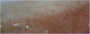 The increased diameter in the irregular dilatation in the nail fold capillaroscopy on a 2.5 years old Kawasaki patient.