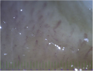 Abnormal morphology and loss of density of capillary vessels in a 14 months Kawaski patient with coronary involvement.