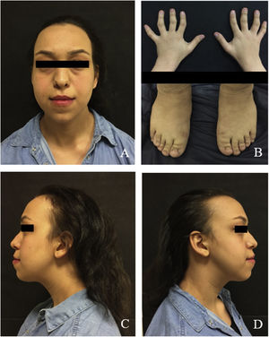 Extraoral view of the patient: (A) frontal view of the patient; (B) radial and ulnar deviation of the distal phalanges; (C and D) profile views of the patient.