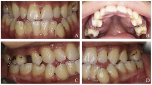 Intraoral view of the patient (1 week after surgery). (A) Anterior open-bite with dental crowding; (B) high-arched palate; (C and D) bilateral posterior cross-bite with dental crowding.