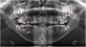Panoramic radiograph (black arrows: 6 permanent impacted teeth, red arrows: 11 supernumerary impacted teeth, yellow arrows: 2 deciduous teeth).